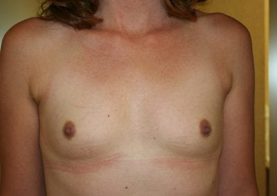 Breast Augmentation Patient Before Surgery