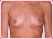 Before Breast Augmentation plastic surgery