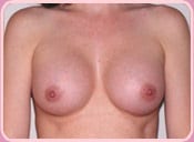 Breasts After Augmentation Procedure