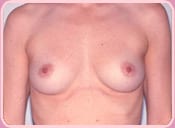 Patient Before Breast Augmentation Procedure