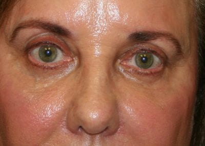 Patient After Eyelid Surgery