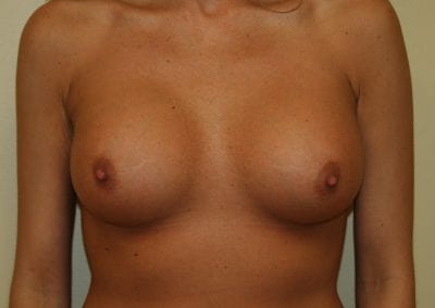 a patient after breast augmentation