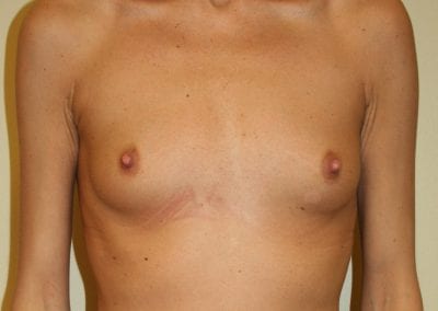 a patient before breast augmentation