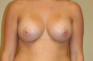 After Breast Augmentation Procedure