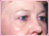 Patient Before Eyelid Surgery