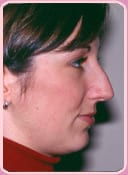 side view of patient before rhinoplasty