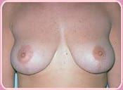 Plastic Surgery Patient After Breast Lift Procedure
