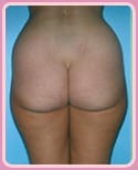 Patient Before Liposuction Procedure