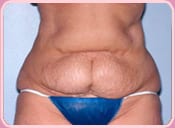 Patient before tummy tuck