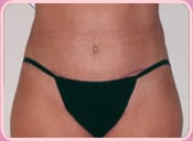 Patient after tummy tuck