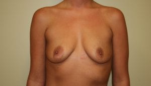 Breast Augmentation Patient Before Procedure