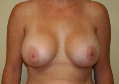 Photo of breasts after breast augmentation