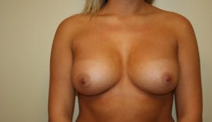 Atter Breast Augmentation Surgery