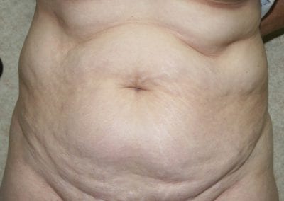 patient's stomach before abdominoplasty