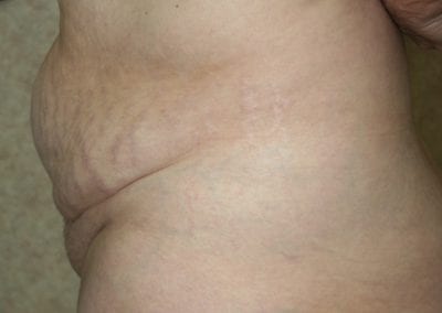side view of patient's belly fat before receiving abdominoplasty procedure