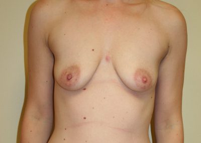 a patient's breasts before breast augmentation