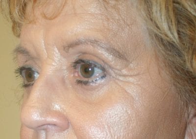 Patient After Eyelid Surgery