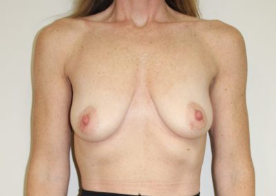 a patient's breasts before breast augmentation