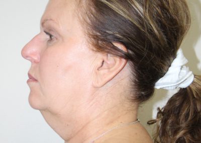 a patient's neck before liposuction