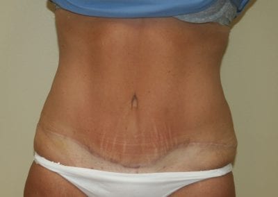 After Abdominoplasty (Tummy Tuck) Procedure