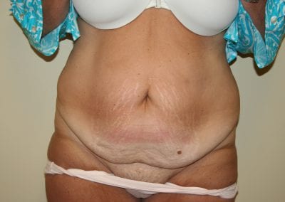 Before Abdominoplasty (Tummy Tuck) Procedure