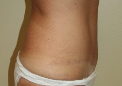 side view of patient's weight loss after receiving abdominoplasty procedure