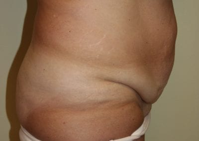 side view of patient's belly fat before receiving abdominoplasty procedure